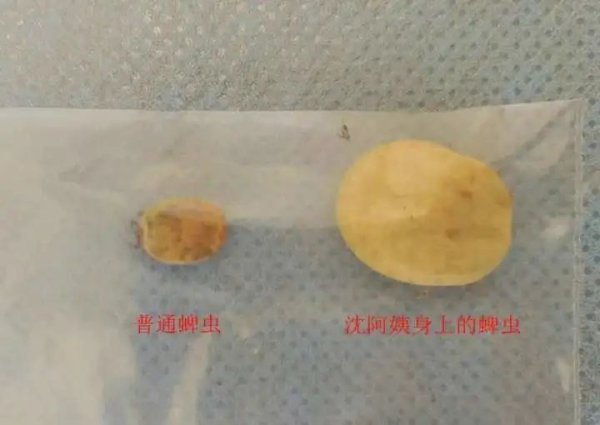 嘉创配资 大腿上长出指甲盖大小的肿块，医生惊讶：这是虫子！从医43年来见过最大的...